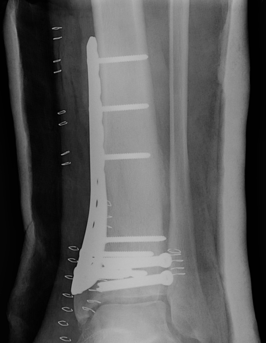 Tibial Plafond ORIF AP